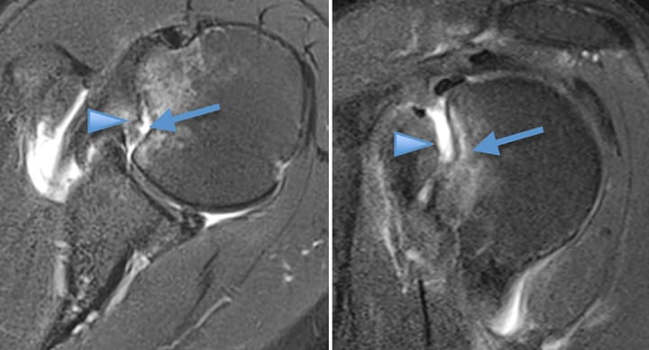 Luxation postérieure de l'épaule