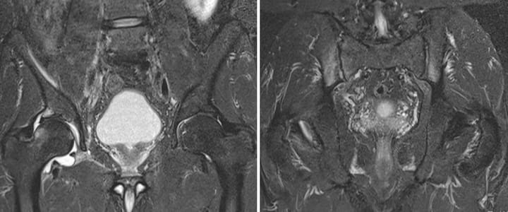 Arthrite de hanche dans le cadre d'une spondylarthropathie