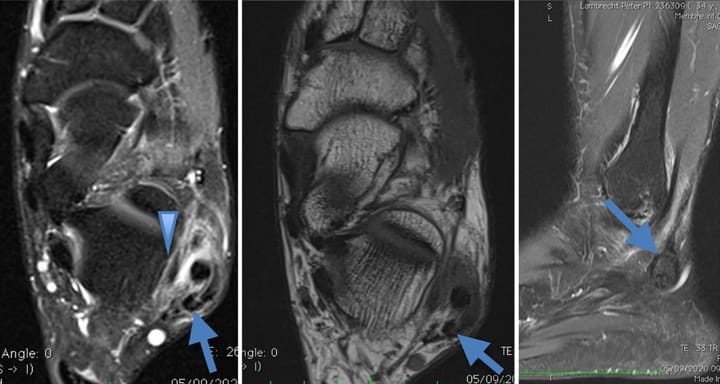 Tendon accessoire de type peroneus quartus
