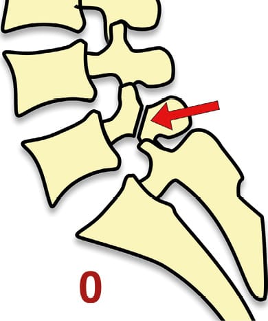 Spondylolyse et spondylolisthésis isthmique chez l'adulte