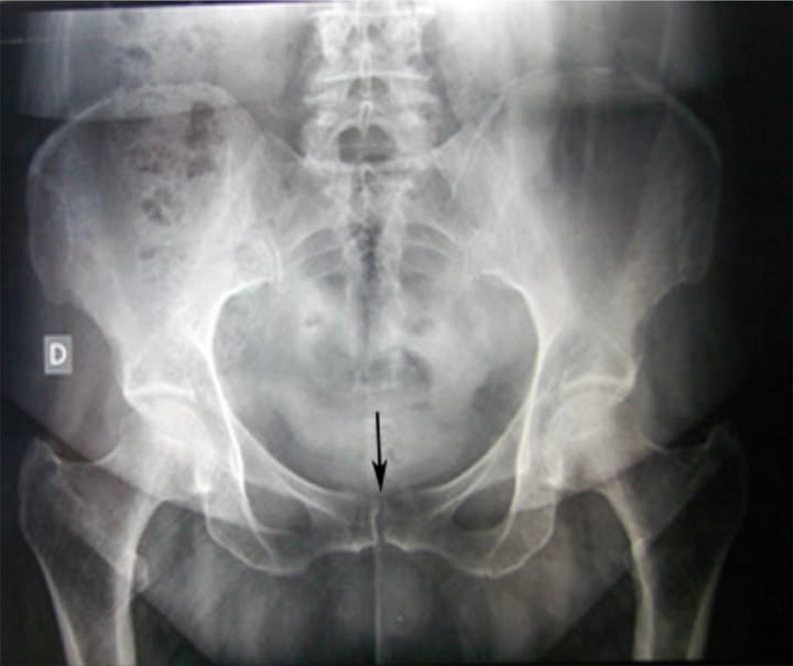 Intérêt du cliché du bassin de face en pratique courante