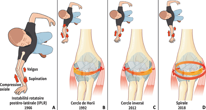 La terrible triade du coude : affronter le réel et dépasser le mythe