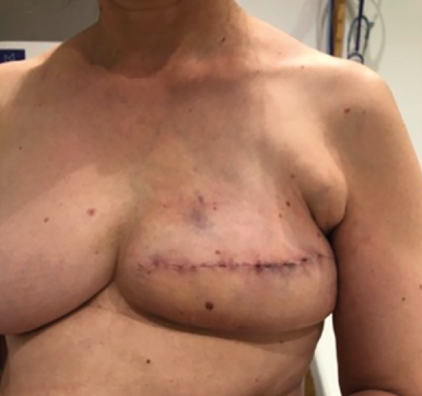 La place du traitement kinésithérapique par compression après ponction d'un lymphcèle thoracique ou axillaire post-mastectomie dans le traitement d'un cancer du sein