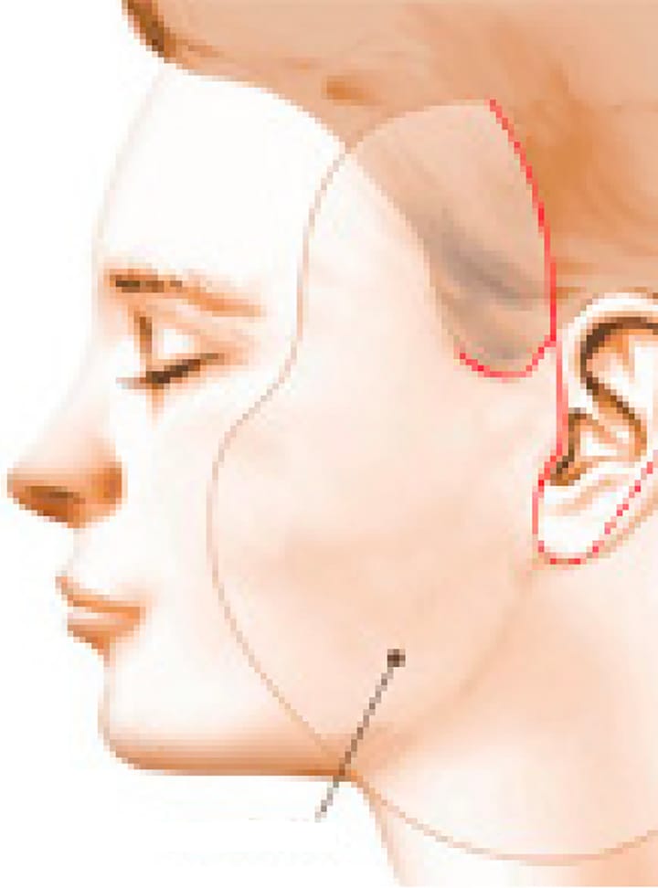 Lifting : livret d'information à l'attention des patients de chirurgie et médecine esthétique