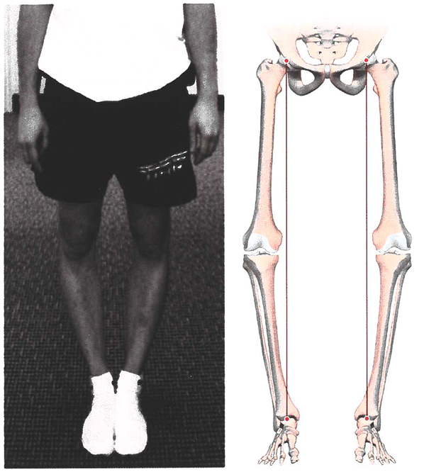 Quelles alternatives à l’alignement mécanique pour les prothèses de genou ? De l'alignement anatomique à l'alignement cinématique
