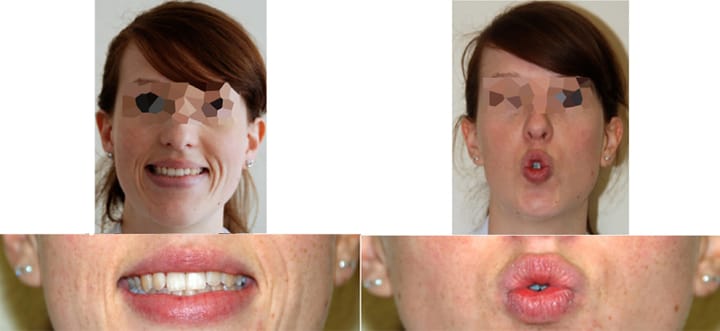 Élaboration d'un protocole d'autorééducation de la paralysie faciale centrale après accident vasculaire cérébral