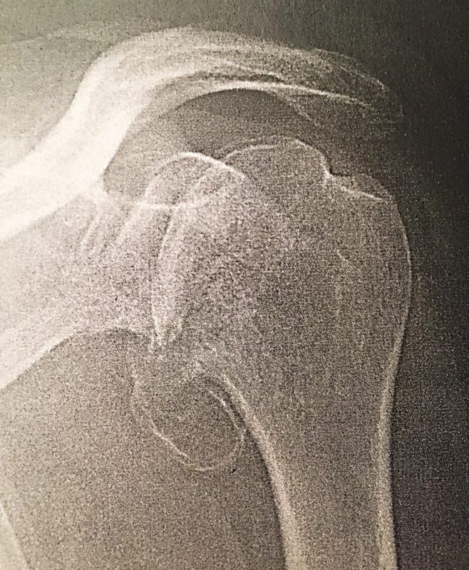 Rééducation des omarthroses