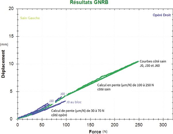Évolution de la résistance des ligamentoplasties (LCA) au cours du temps : influence des sollicitations précoces sur la raideur finale de la plastie en postopératoire