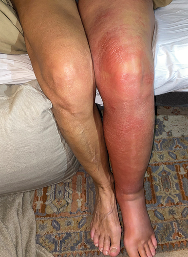 Mon lymphoedème, entre technique et présence humaine