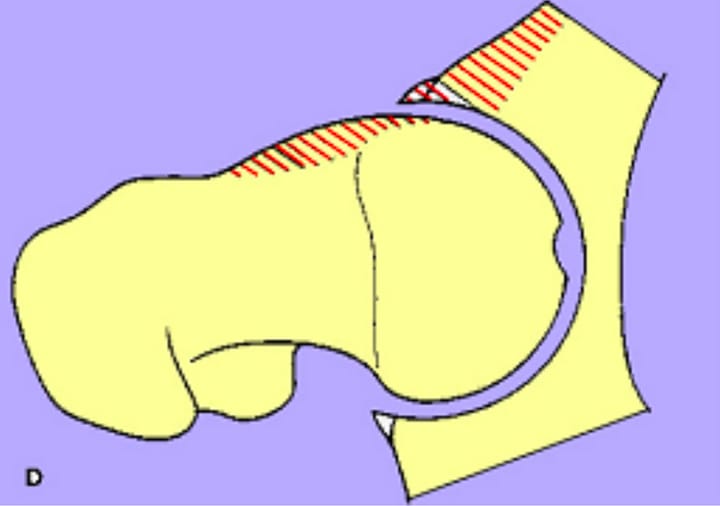 Le conflit fémoro-acétabulaire