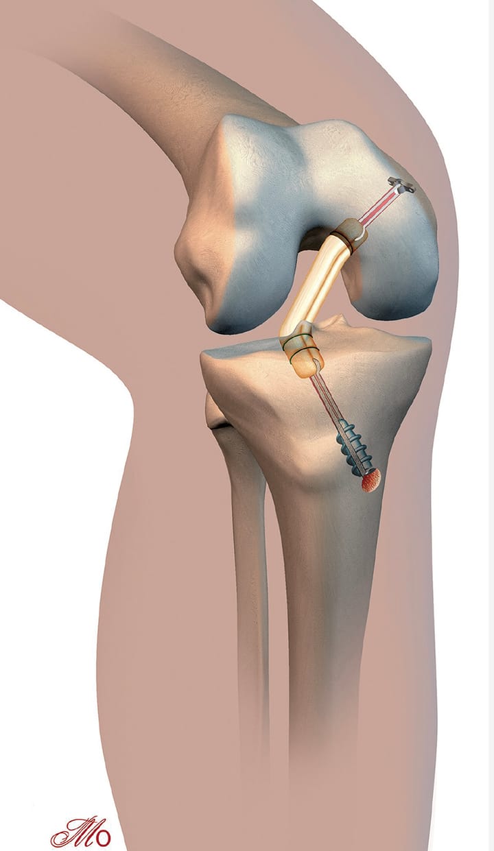 Reconstruction du ligament croisé postérieur du genou sous arthroscopie