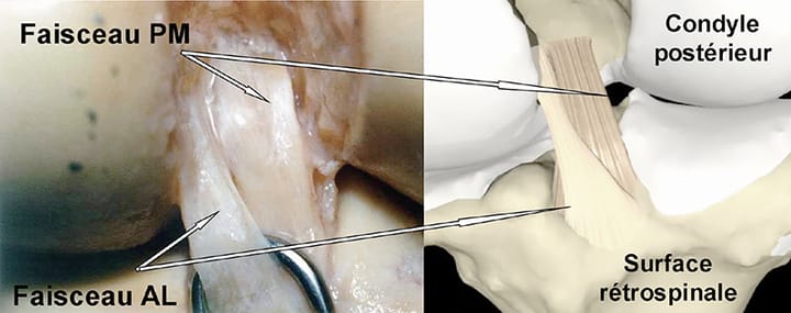 Chirurgie du LCP en 2018 : Synthèse bibliographique.