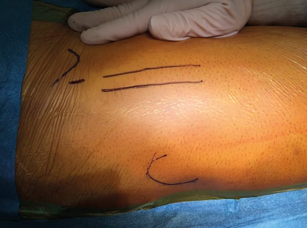 Quelle voie d'abord pour une prothèse totale de hanche chez le sportif ?