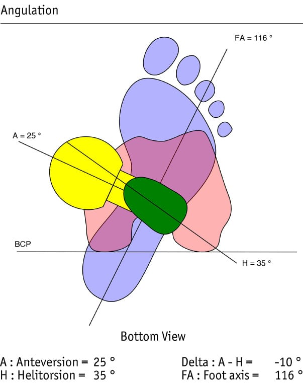 Prothèse totale de hanche sur mesure : pour qui ? pourquoi ? comment ?