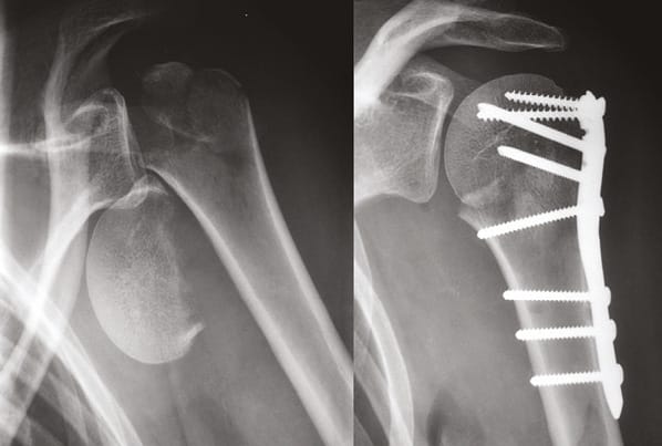Traumatologie du ski alpin et du surf des neiges : 45 ans d'expérience à l'Hôpital sud de Grenoble