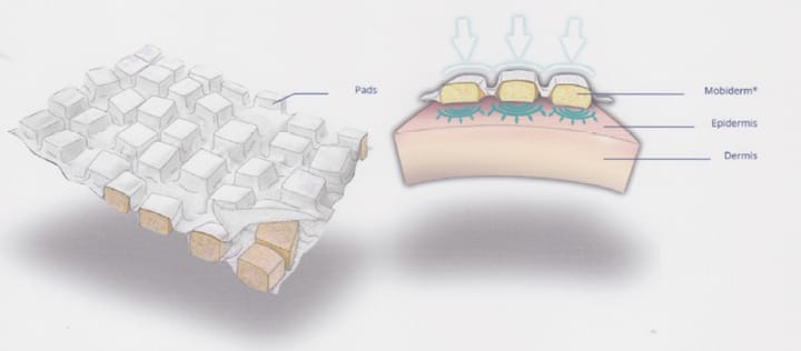 Décongestion des lymphœdèmes : bénéfice de l'ajout d'une bande à plots sous la botte de pressothérapie séquentielle