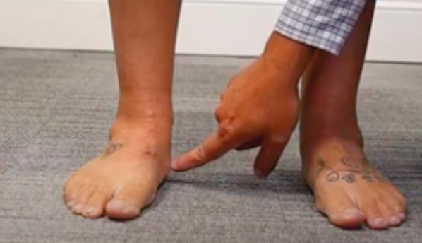 Périostite chez les coureurs récréatifs : facteurs de risque, traitement et prévention