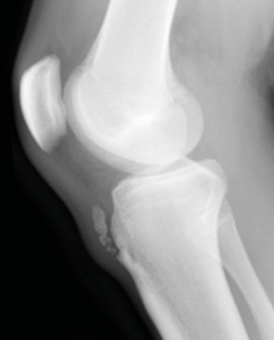 La maladie d'Osgood-Schlatter : prise en charge éclairée