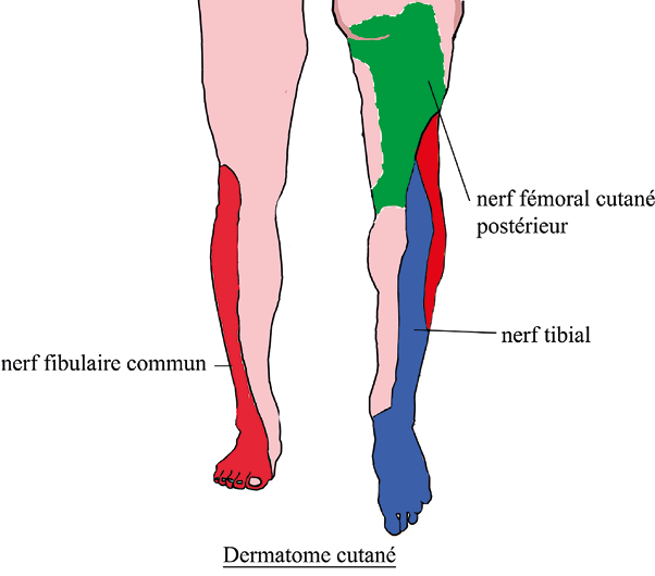 Peut-on faire la différence entre une douleur sciatique d'origine tronculaire ou radiculaire ?