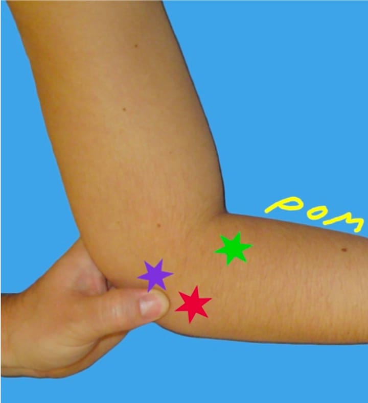 Diagnostic différentiel de dysfonction entre une épicondylalgie d'origine musculaire et d'origine neurale (1ère partie)