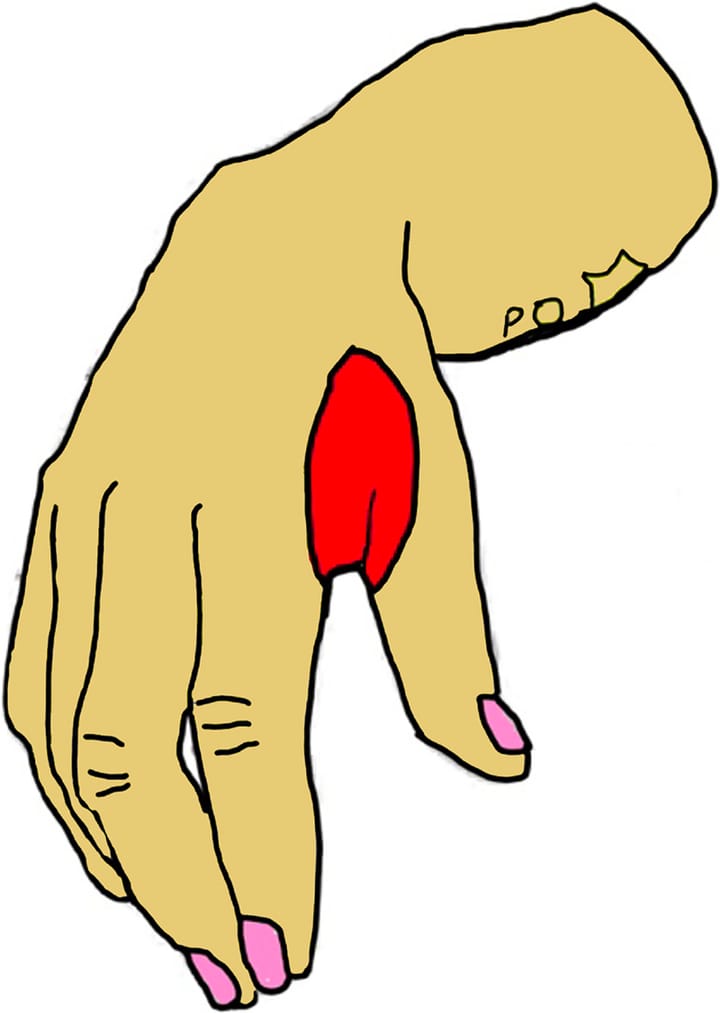 Tendinopathie de De Quervain et névrite de Wartenberg : raisonnement clinique