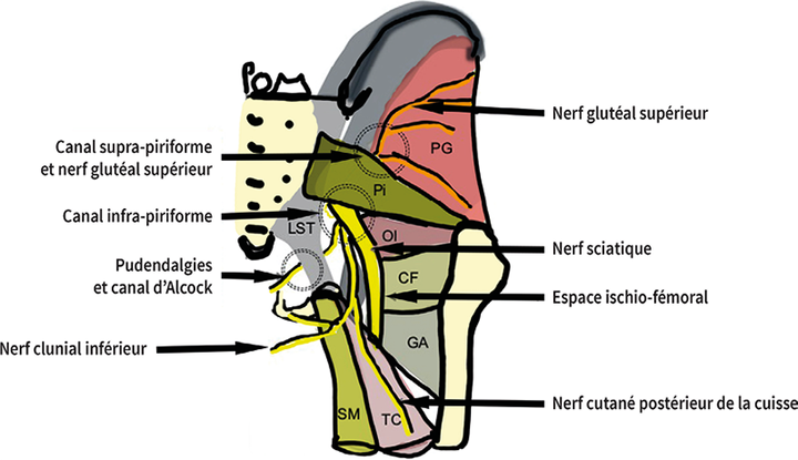 Sciatique et fausse sciatique : est-ce toujours d'actualité ?