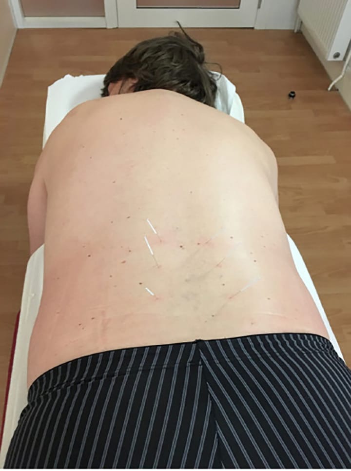 Efficacité de la puncture kinésithérapique dry needling (DN) / pathologie (1ère partie)
