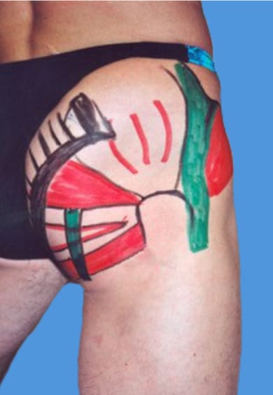 Conflit ischio-fémoral (1ère partie)