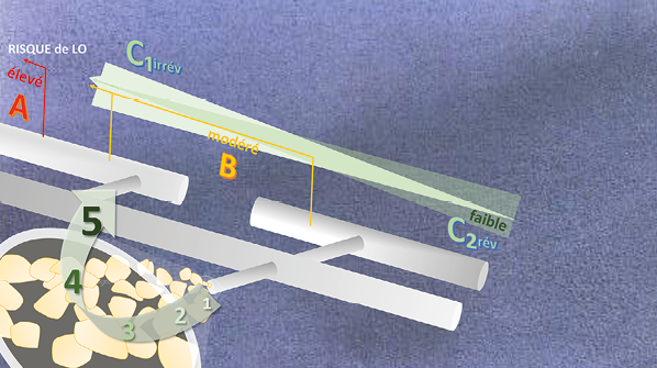 Pressothérapie intermittente des lymhoedèmes irréversibles du membre supérieur de l'interaction de l'intermittence sur la pression