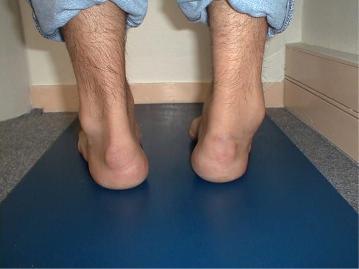 L'instabilité chronique de cheville : biomécanique, diagnostic et méthodes thérapeutiques