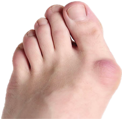 Quelle restauration de la marche après chirurgie correctrice de l'hallux valgus ?