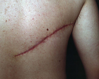 La peau : impact des traitements dans le cancer du sein