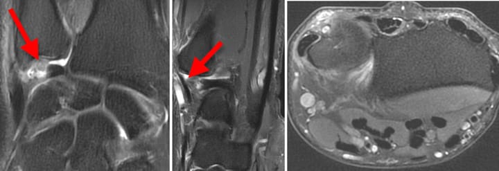 Lésion traumatique du ligament triangulaire du carpe