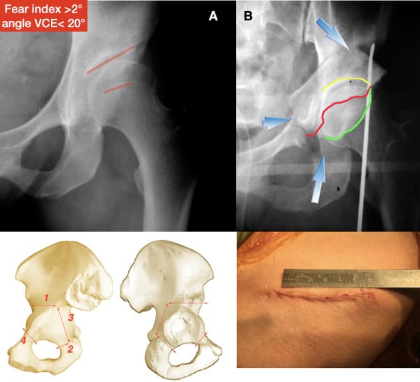 La micro-instabilité de hanche : un nouveau concept qui fait son chemin (2e partie)