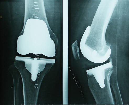 Drainage manuel et œdème après arthroplastie du genou : utile ou non ?