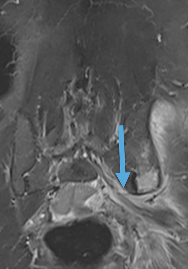 Métastase osseuse avec extension dans le canal sous-piriforme avec irritation du nerf sciatique