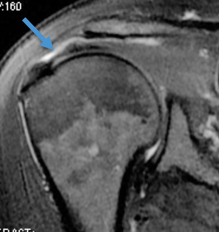 Rupture non transfixiante de la face bursale du supra-épineux antérieur