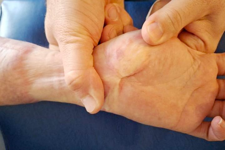 Kinésithérapie des grands brûlés : prise en charge en cabinet libéral