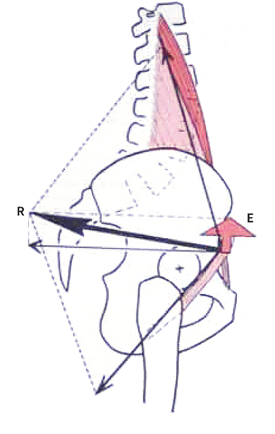 Douleur inguinale après une prothèse totale de hanche : conflit du psoas (diagnostic et prise en charge)