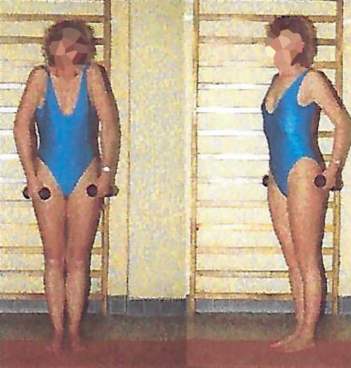 Place de la rééducation dans le traitement du syndrome de la traversée thoraco-brachiale (2ème partie)