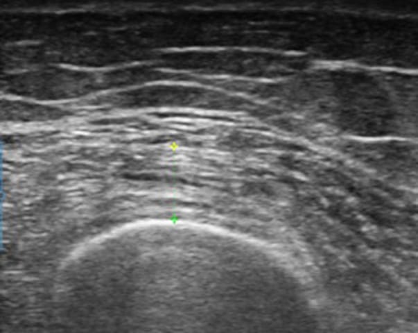 Échographie de la fonction musculaire périphérique chez le patient atteint d'obésité