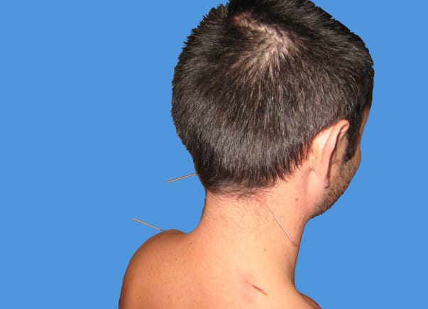 Migraines et céphalées de tension : traitement non médicamenteux sur des preuves (2e partie)