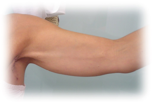 Drainage lymphatique manuel et exercices pour les thromboses lymphatiques superficielles essai clinique randomisé