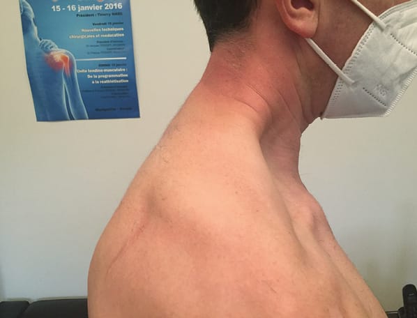 L'épaule douloureuse : de l'examen au raisonnement clinique (2e partie)