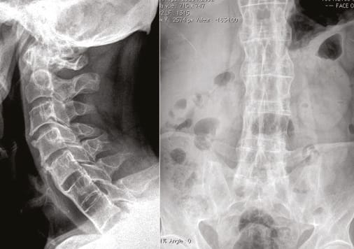 Spondylarthropathie