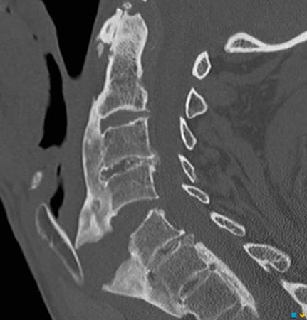 Fracture sur hyperostose vertébrale ankylosante