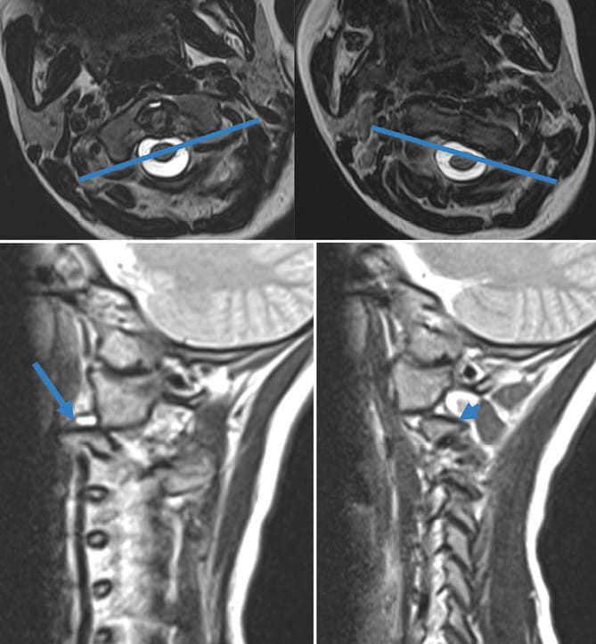 Dislocation rotatoire C1-C2 / syndrome de Grisel