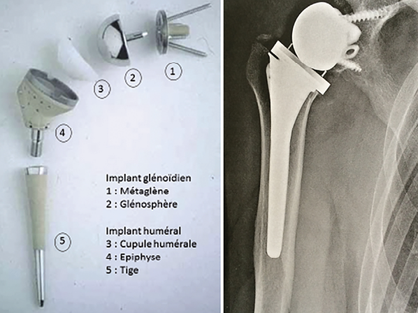 Épaule : existe-t-il un lien entre la biomécanique et la clinique ?