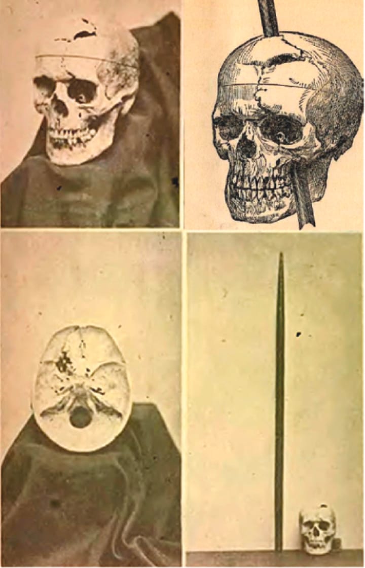 Connaissez-vous Phineas Gage ?