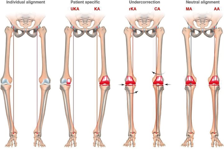 Alignement mécanique ajusté pour obtenir un genou équilibré avec moins de libération ligamentaire conseils et astuces chirurgicales d'une technique modifiée d'ajustement de l'espace en extension dans l'arthroplastie de genou
